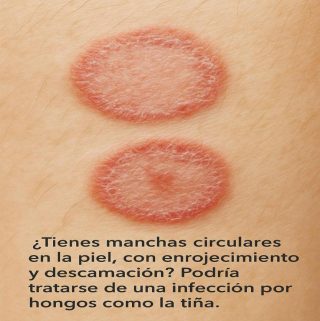 Remedios caseros para la alergia en la piel