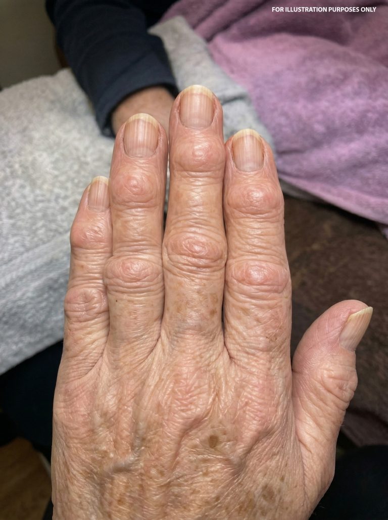 My grandma started getting hard bumps near her fingernails… and now they’re spreading. What’s really causing this—and should we be worried?
