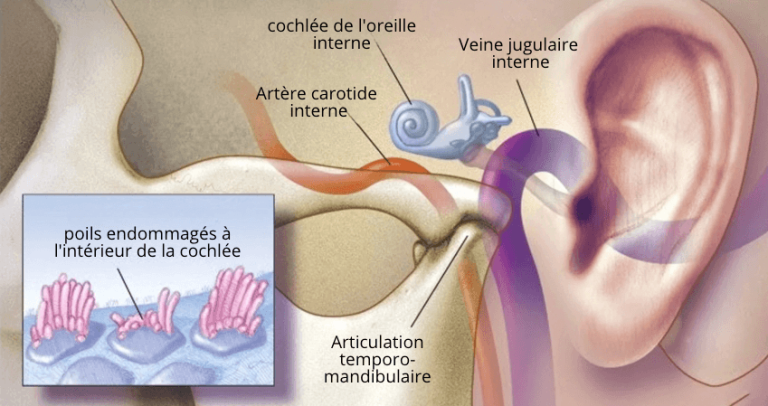Acouphènes : Elle n’en pouvait plus… Jusqu’à ce que son petit-fils médecin découvre un remède naturel qui lui redonne enfin le silence