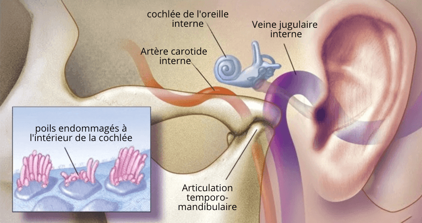 Acouphènes : Elle n’en pouvait plus… Jusqu’à ce que son petit-fils médecin découvre un remède naturel qui lui redonne enfin le silence