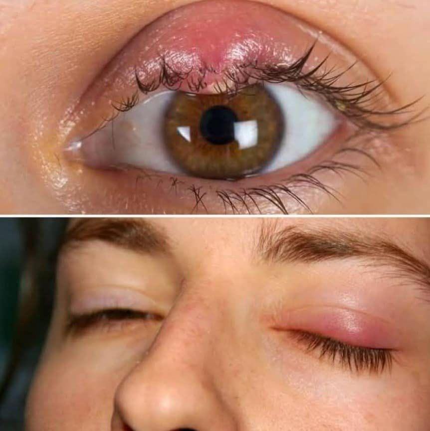 Orzuelos en el ojo: Descubre remedios naturales para aliviar la incomodidad y acelerar la curación.VER MÁS