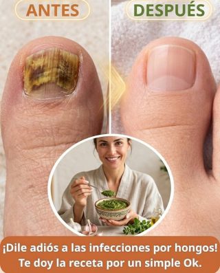 Adiós a los Hongos! El Remedio Casero Antimicótico que Transformará tus Pies y Uñas