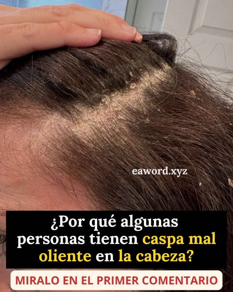Si tienes caspa significa sin duda que tienes…
