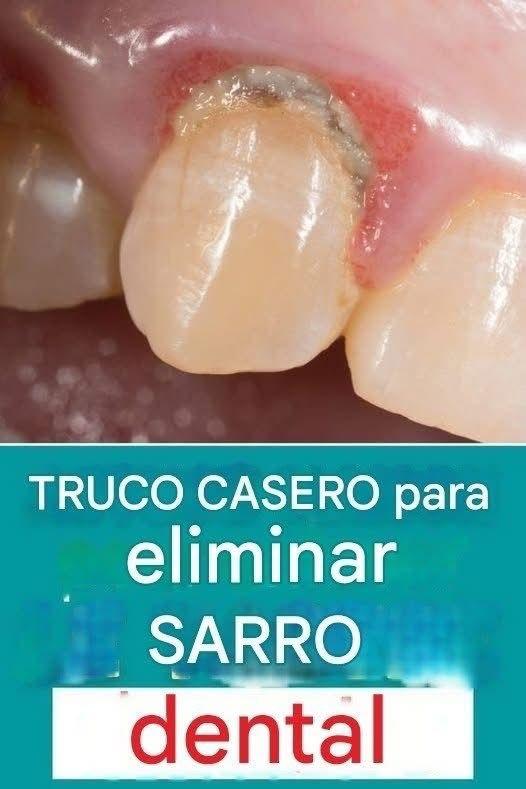 Consejo casero para eliminar el sarro tú mismo