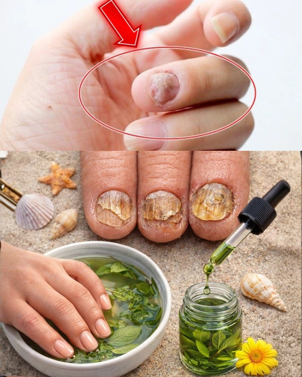 Lo llaman el “rompedor de hongos” porque,, con una sola aplicación, elimina todos los hongos y callos de las uñas de los pies. Aquí te contamos cómo prepararlo… ¡Más información abajo!