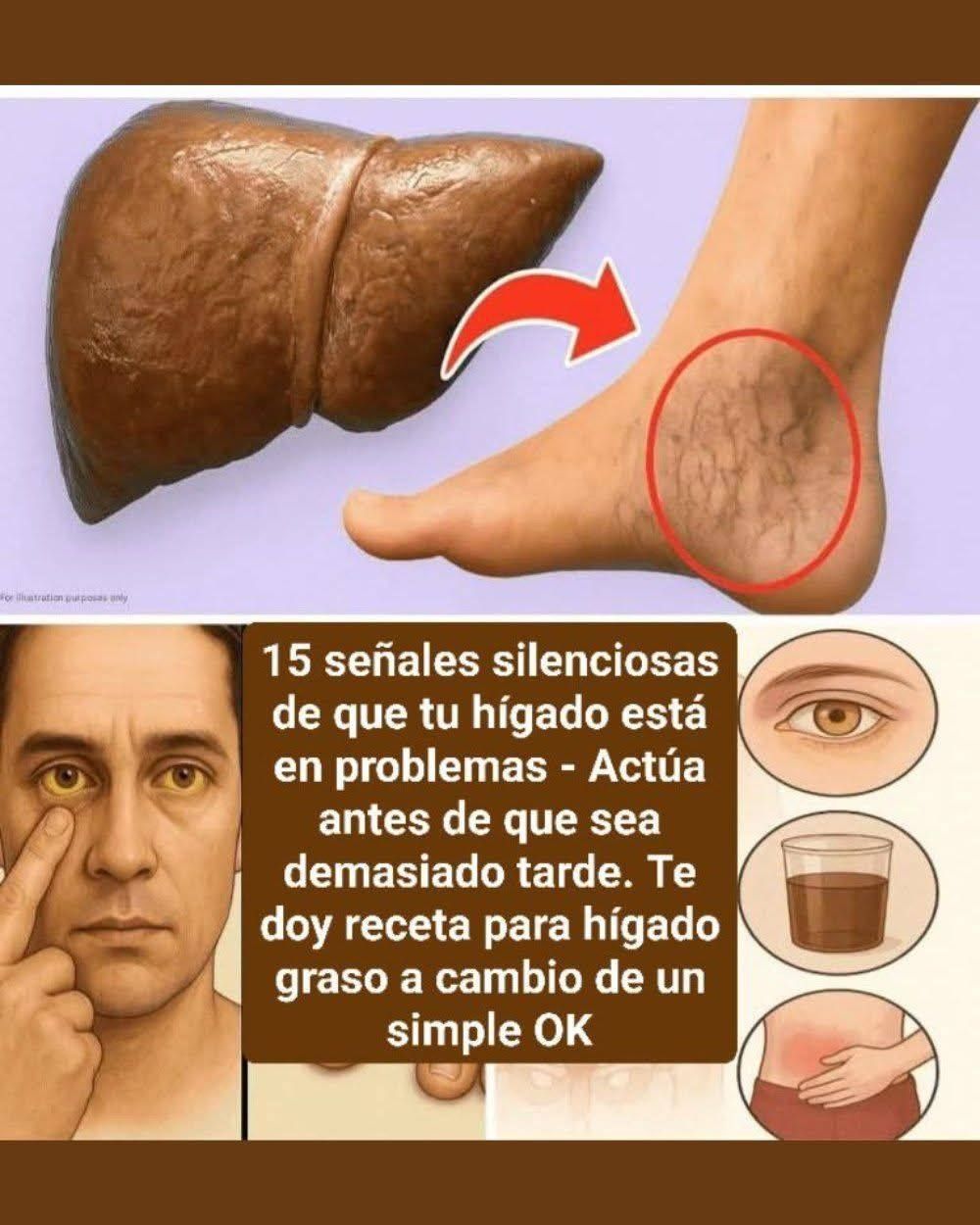Principales Síntomas del Hígado Graso: Señales que No Debes Ignorar……….ver mas