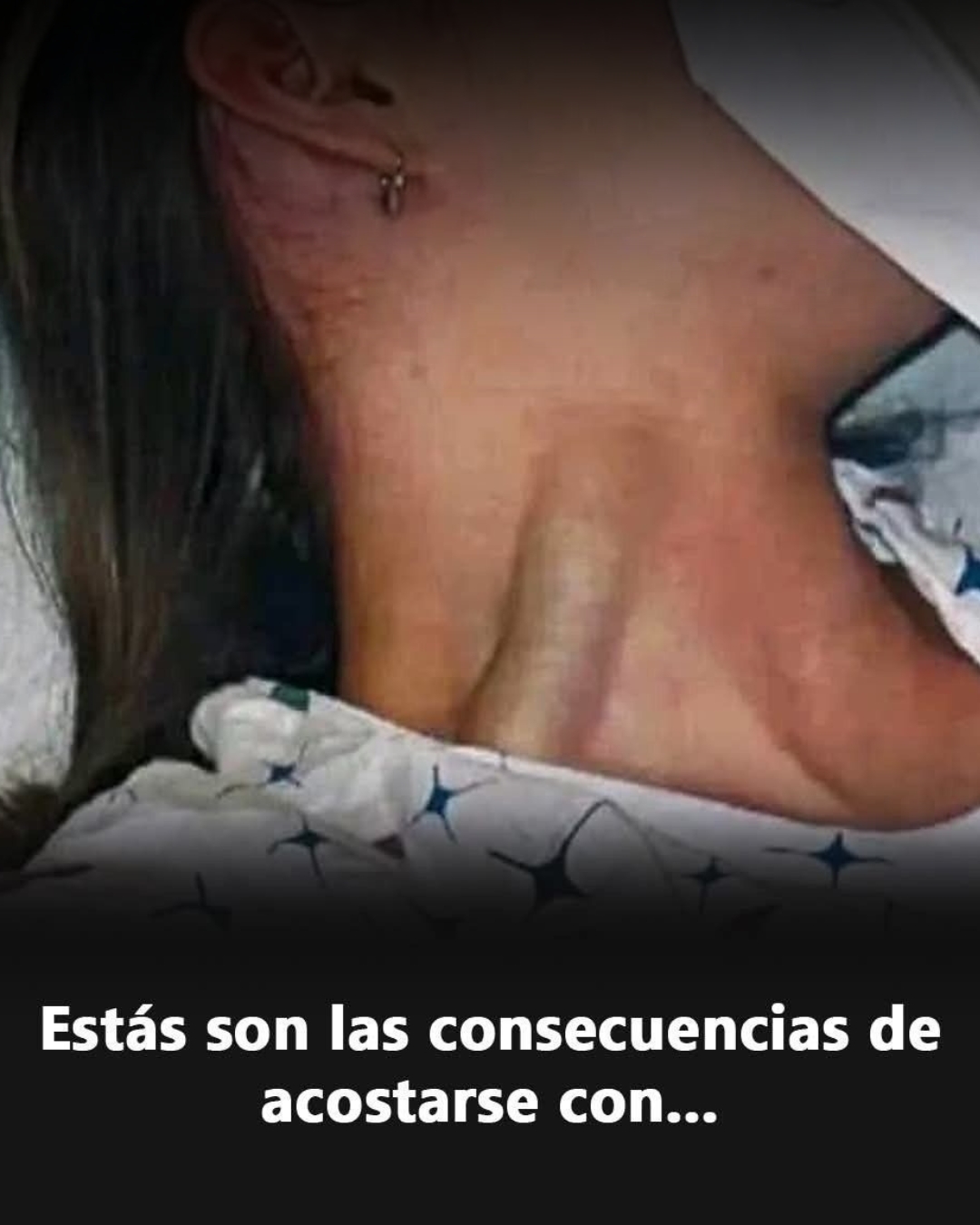 Distensión Yugular Masiva: Causas, Diagnóstico y Tratamiento