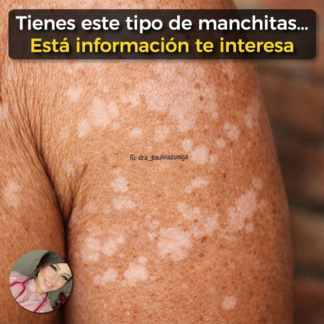 ¿Te han salido pequeñas manchas blancas en brazos o piernas… y no sabes qué son? 🤔