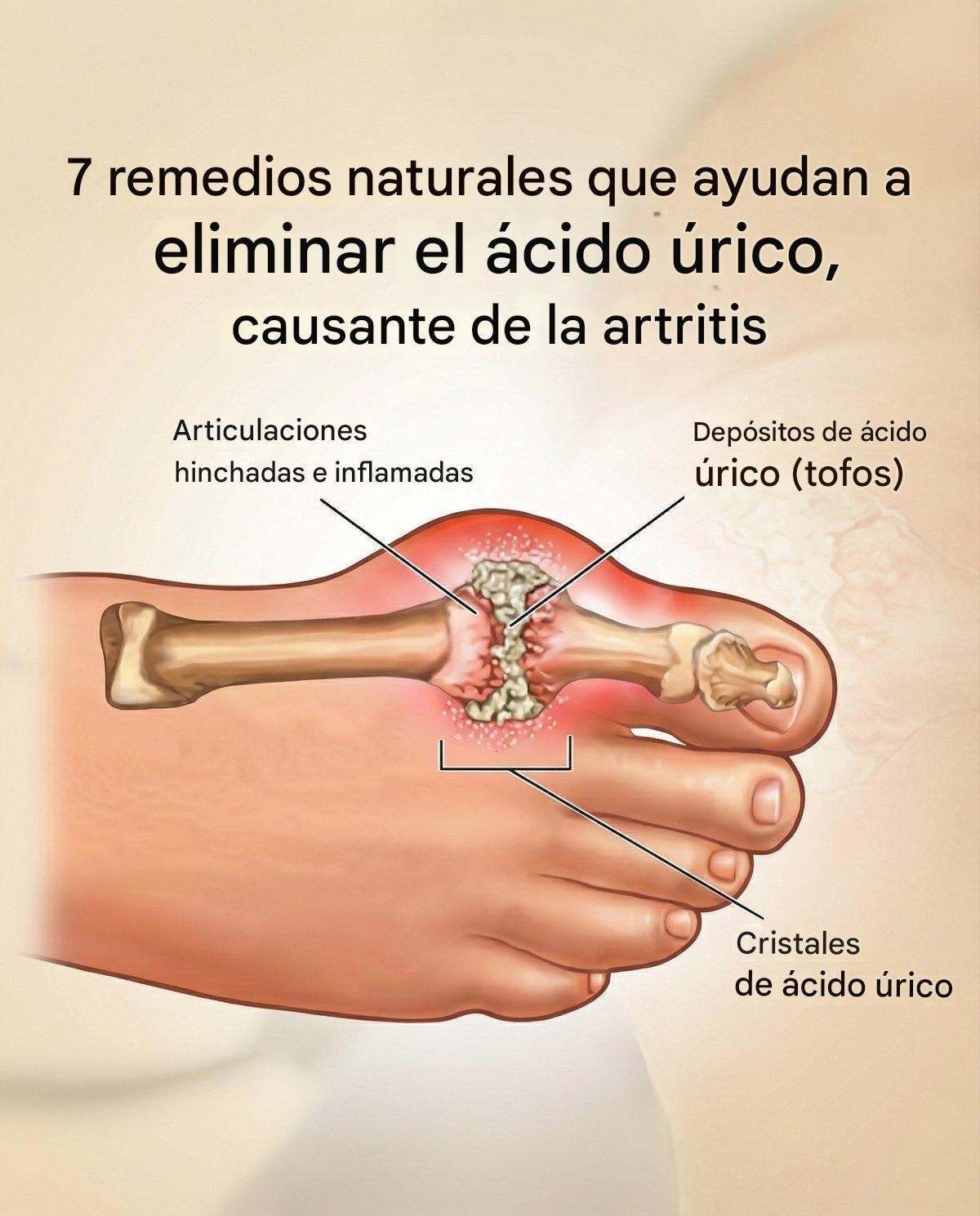 7 remedios naturales que ayudan a eliminar el ácido úrico que causa artritis