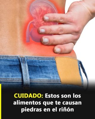 Aumentan los casos de jóvenes con piedras en los riñones: estos son los alimentos que más dañan tu salud