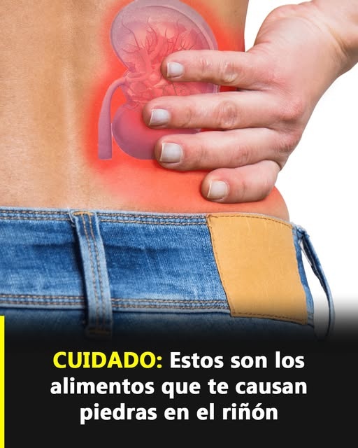 Aumentan los casos de jóvenes con piedras en los riñones: estos son los alimentos que más dañan tu salud