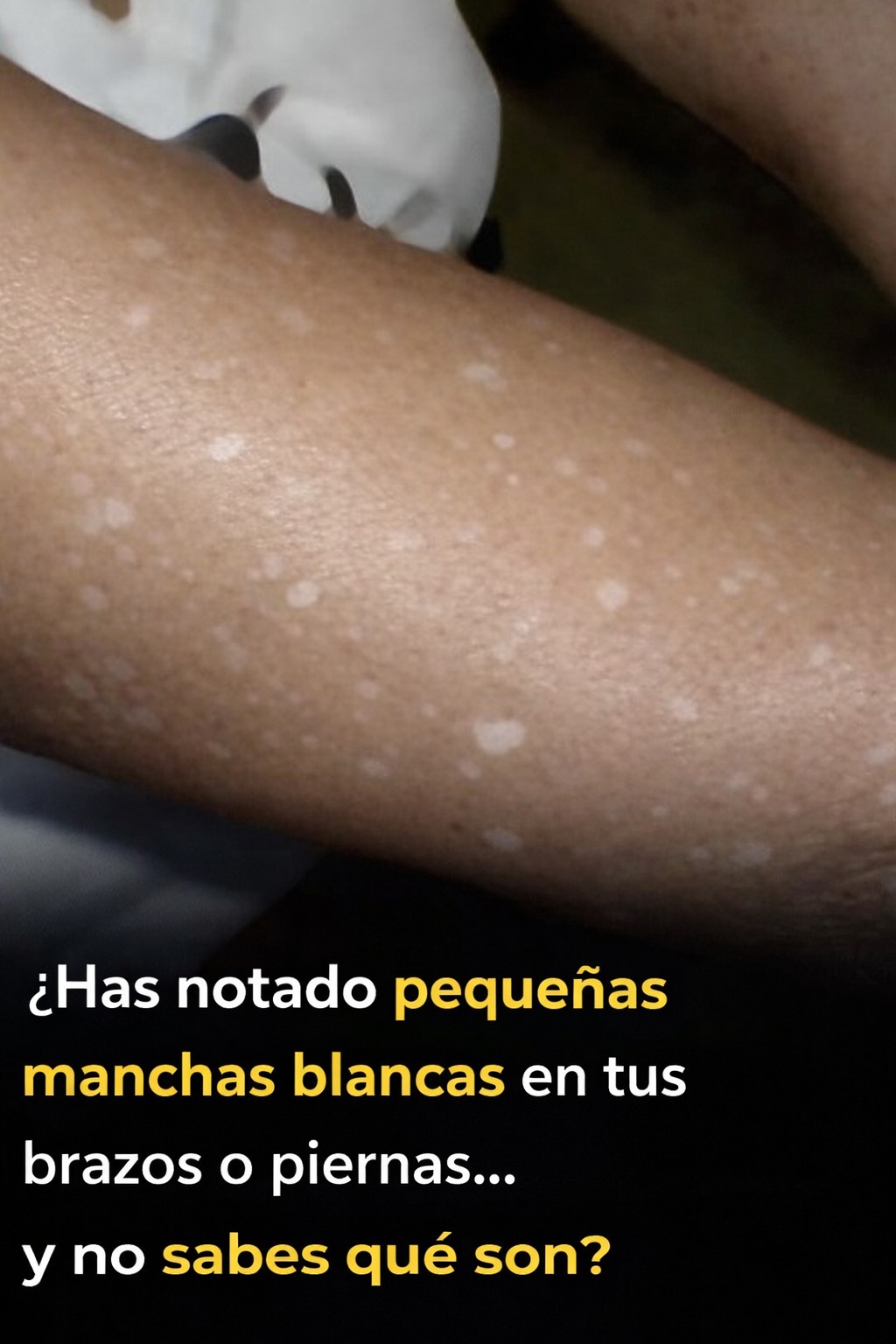 Pequeñas manchas blancas en brazos y piernas: lo que necesitas saber……….ver mas
