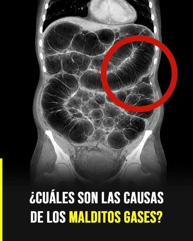 Gases intestinales frecuentes: las verdaderas causas que casi nadie explica con claridad