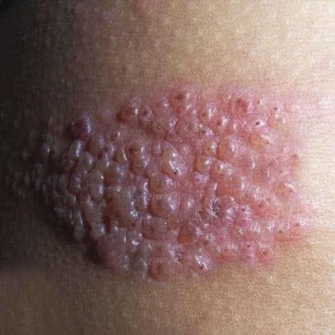 Culebrilla advertencia