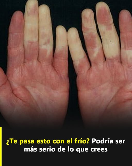 ¿Tus dedos cambian de color con el frío? Podría ser más serio de lo que crees