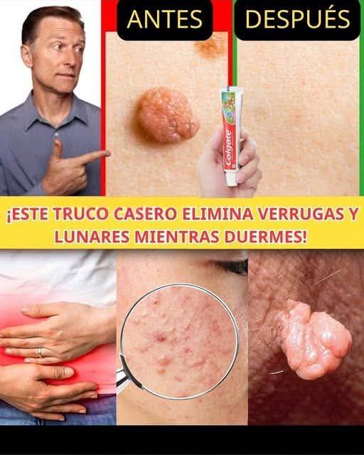 Remedio natural para remover verrugas