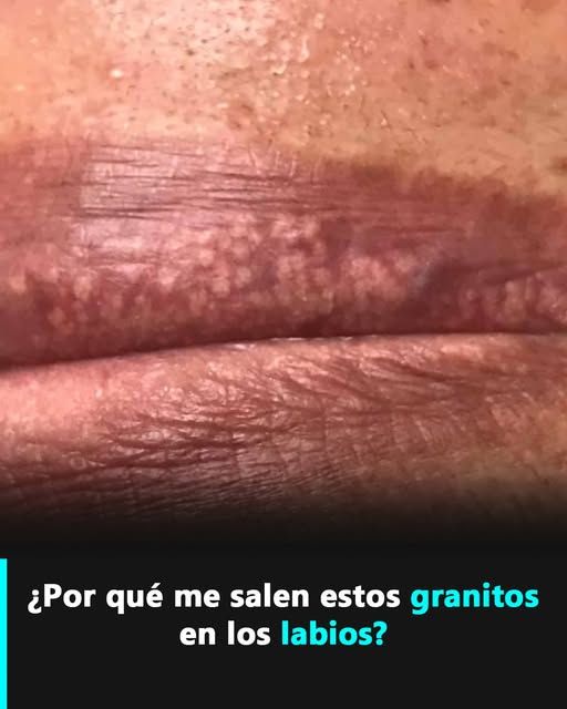 Granos de Fordyce, todo acerca de ellos