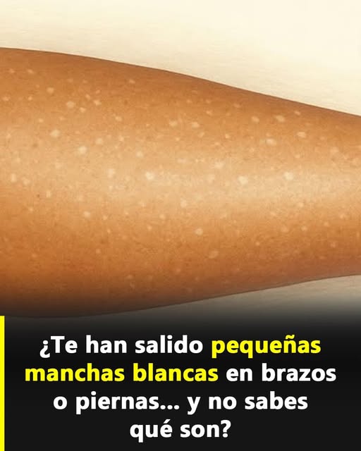 Manchas blancas en la piel: qué son y por qué aparecen según especialistas