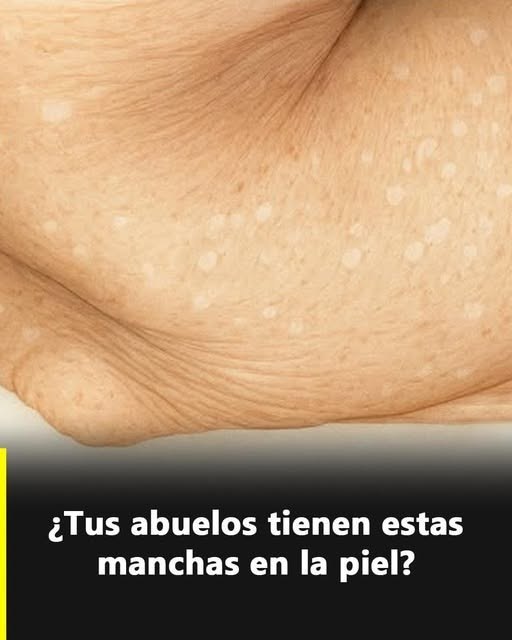 Manchas blancas en la piel: qué son y por qué aparecen según especialistas