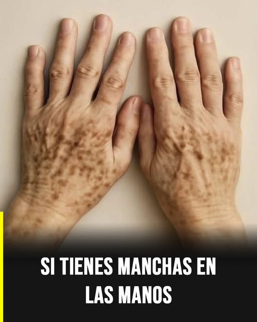 Manchas en las manos: señales visibles que podrían reflejar tu estado de salud