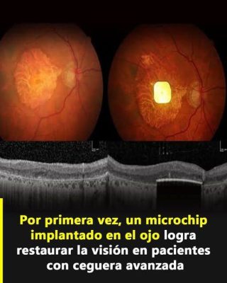 Microchip ocular promete devolver visión funcional a personas con ceguera avanzada