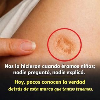 Cinco ideas equivocadas sobre la cicatriz redonda en la parte superior del brazo