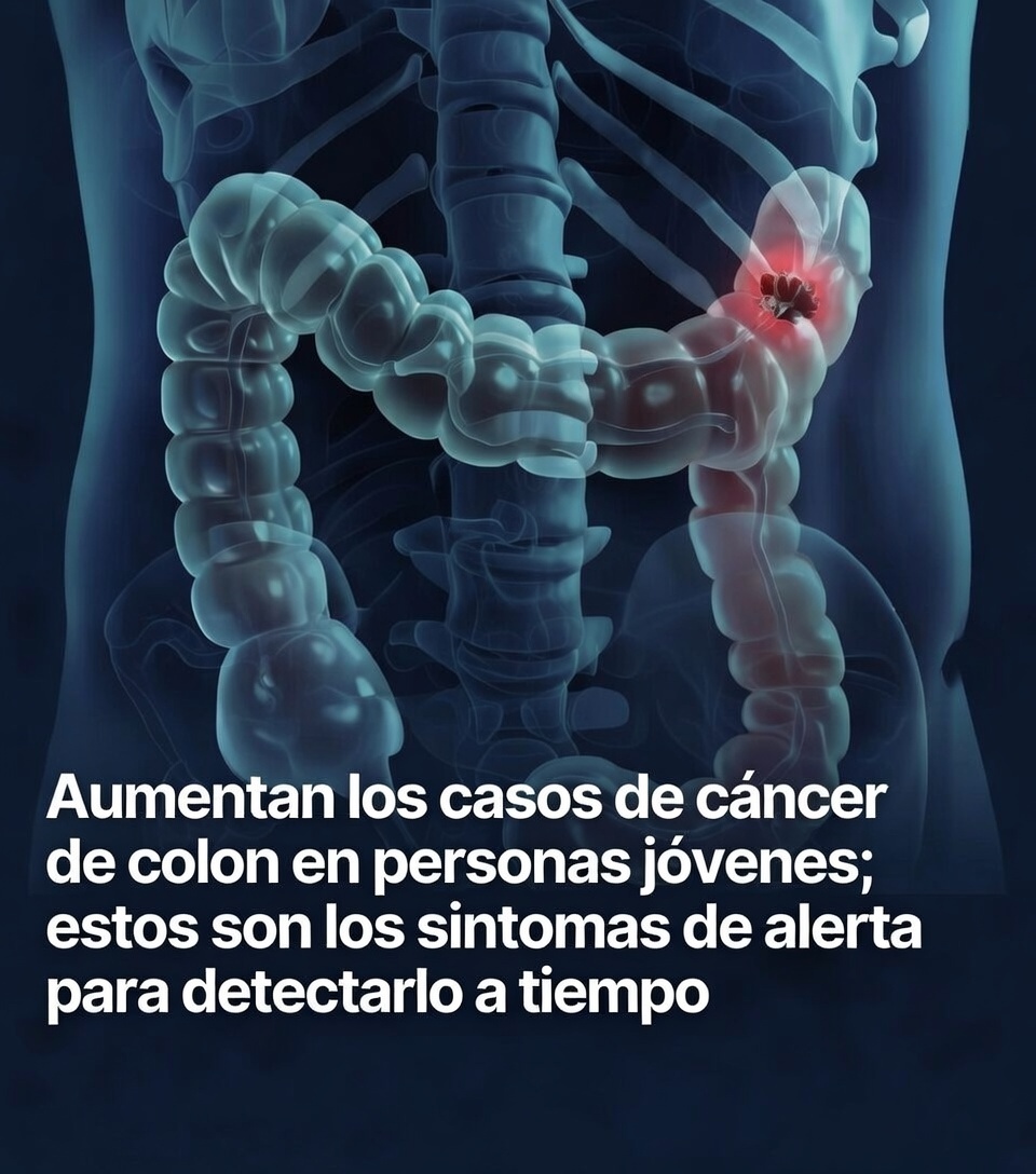 6 sintomas SILENCIOSOS del Cáncer de Colon y Recto. Detéctalo a Tiempo!