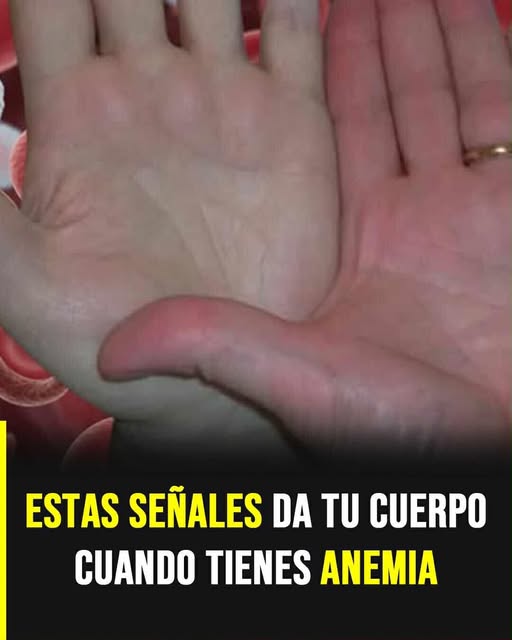 Anemia: las señales silenciosas que pueden indicar falta de oxígeno en la sangre