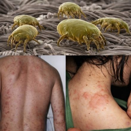 No dejes que los ácaros en tu cama y ropa te coman vivo! Rocíales esto y no volverás a saber de ellos