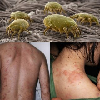 No dejes que los ácaros en tu cama y ropa te coman vivo! Rocíales esto y no volverás a saber de ellos