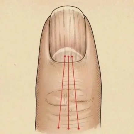 Si tienes las uñas con estas lineas debes poner atención