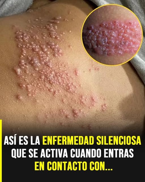 Lo que pocos saben sobre esta enfermedad silenciosa que puede aparecer sin aviso