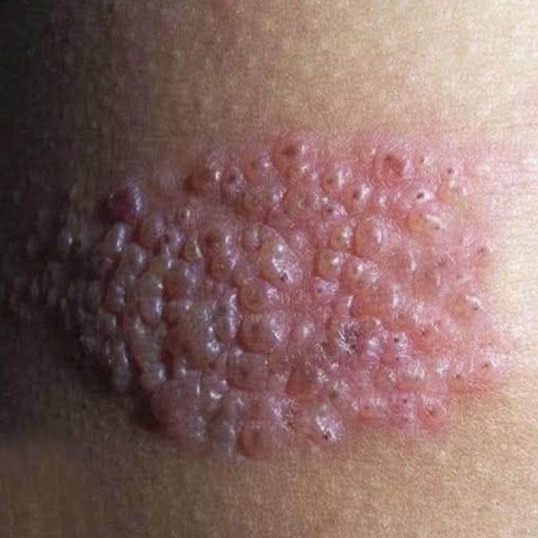 Culebrilla advertencia