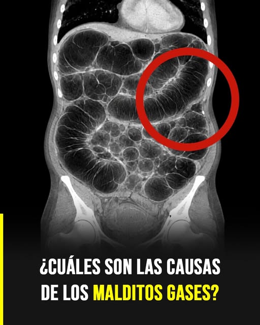Gases intestinales frecuentes: las verdaderas causas que casi nadie explica con claridad