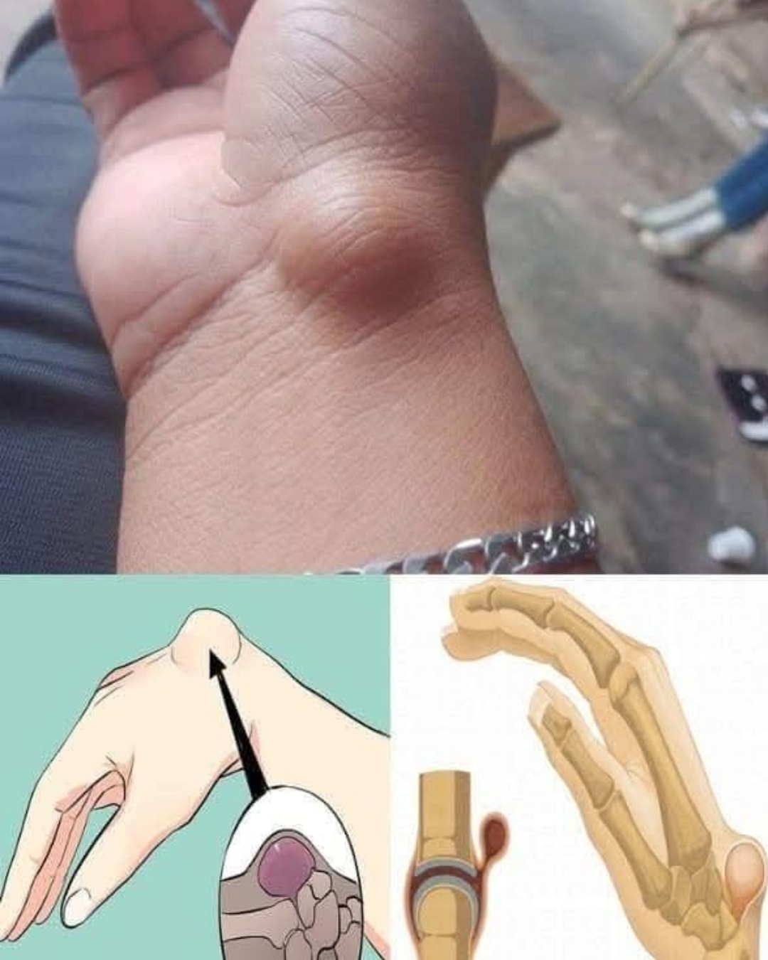 Elimina los Lipomas o Bolas de Grasa