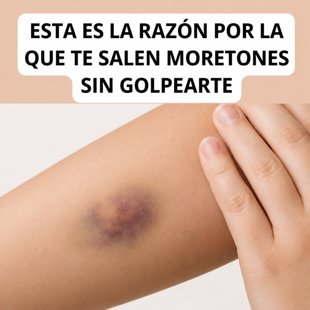 Mucho Cuidado: Esta es la Razón por la que Te Salen Moretones en el Cuerpo Sin Golpearte