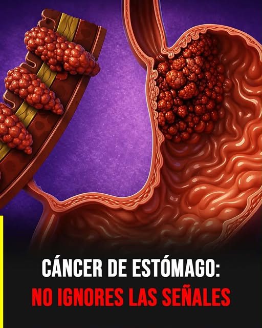 Cáncer de estómago: señales de alerta que no deberías ignorar