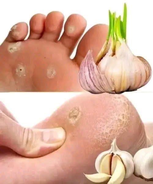 Lo Que tus Pies Revelan: Señales de Problemas de Salud y Remedios Naturales que Ayudan