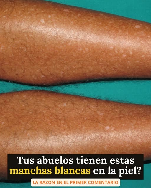 Las manchas blancas en la piel: qué son y por qué aparecen.
