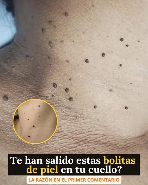 ¿Que son estas bolitas que salen en el cuello y por qué aparecen?