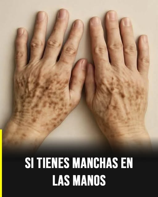 Manchas en las manos: señales visibles que podrían reflejar tu estado de salud
