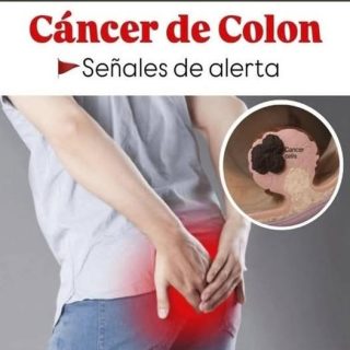 La tasa del cáncer de colon aumenta, conoce los 5 síntomas que debes tener en cuenta.