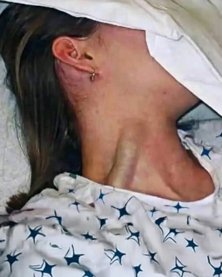Ingurgitación yugular: qué significa este signo y por qué puede alertar sobre tu salud