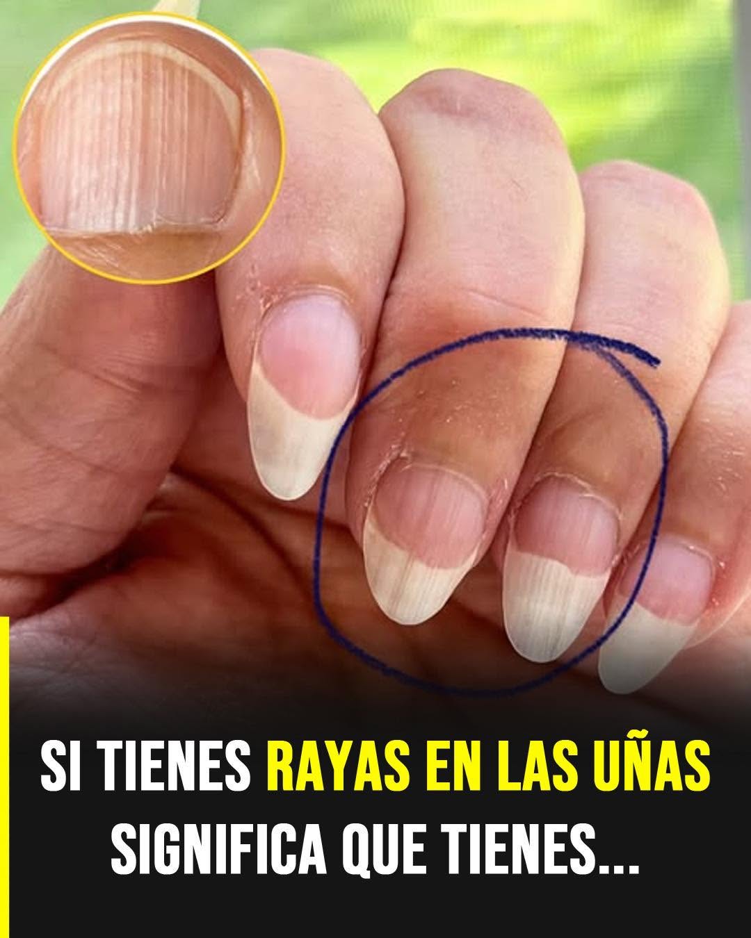 Líneas en las uñas: lo que estas marcas pueden revelar sobre tu salud