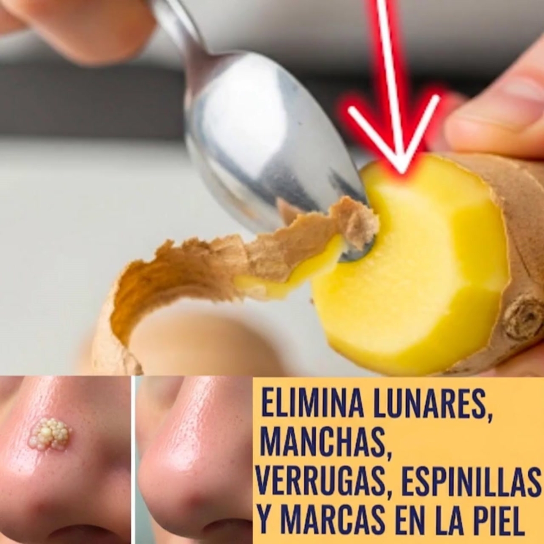 Olvídate de las cirugías: esto es lo que tienes que hacer para eliminar una verruga