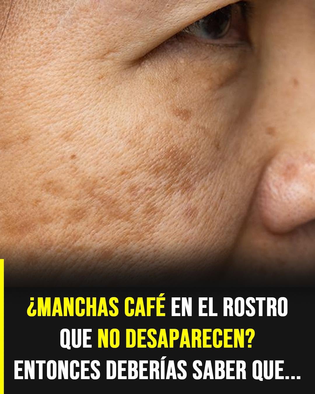 Manchas oscuras en el rostro que no desaparecen