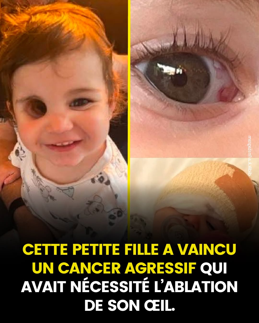 Una niña nació con un cáncer ocular agresivo que requería que le extirparan el ojo, y su curación movía los corazones de muchos