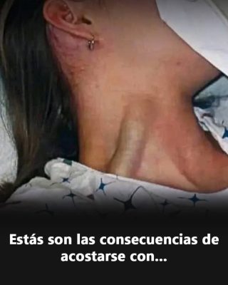 Distensión Yugular Masiva: Causas, Diagnóstico y Tratamiento