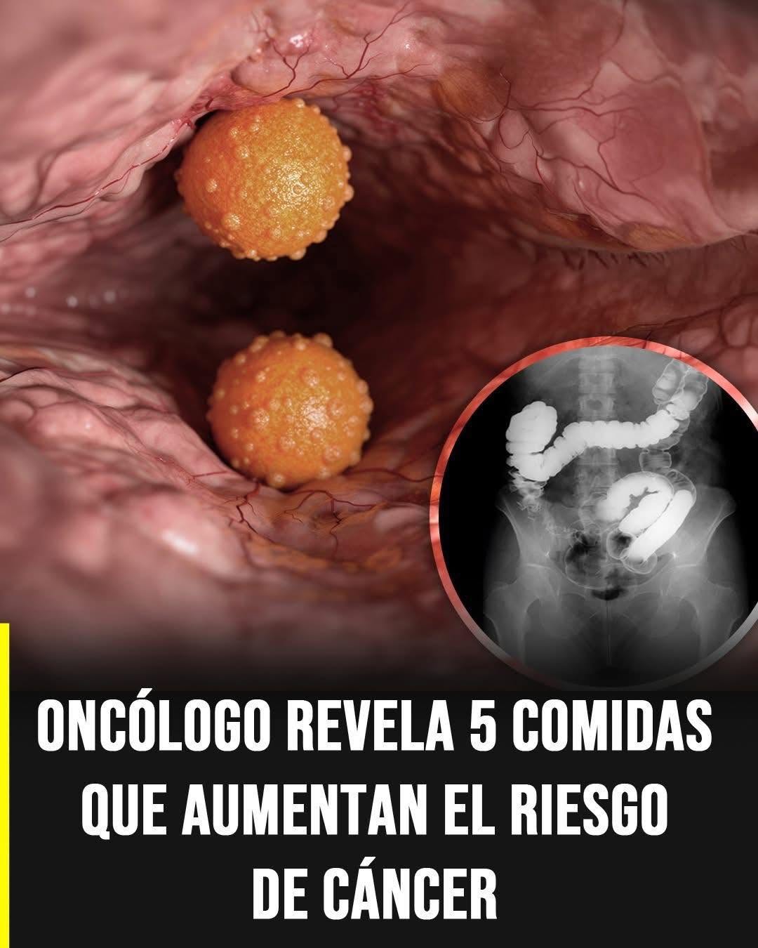 5 comidas que podrían aumentar el riesgo de cáncer si se consumen en exceso