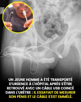 Un jeune homme a été transporté d’urgence à l’hôpital après s’être retrouvé avec un câble USB coincé dans l’urètre : il essayait de mesurer son pénis et le câble s’est emmêlé